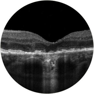 Horizontal OCT scan over the fovea