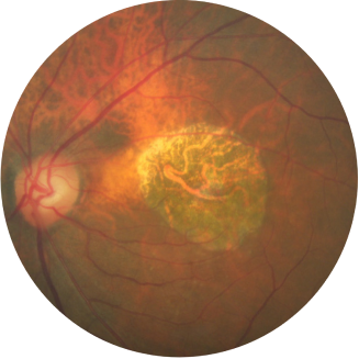 Fundus photograph of an eye with geographic atrophy