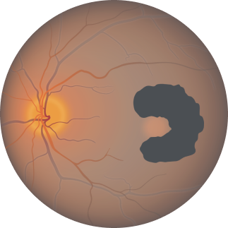 Geographic atrophy progression is continuous and irreversible