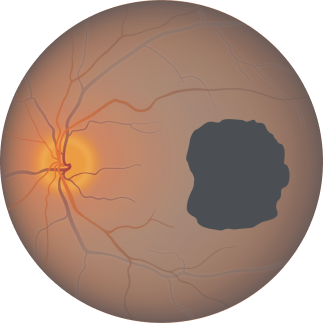 Geographic atrophy progression is continuous and irreversible