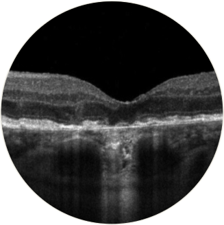 Spectral-domain optical coherence tomography