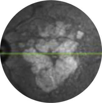 Near-infrared reflectance combined with fundus autofluorescence